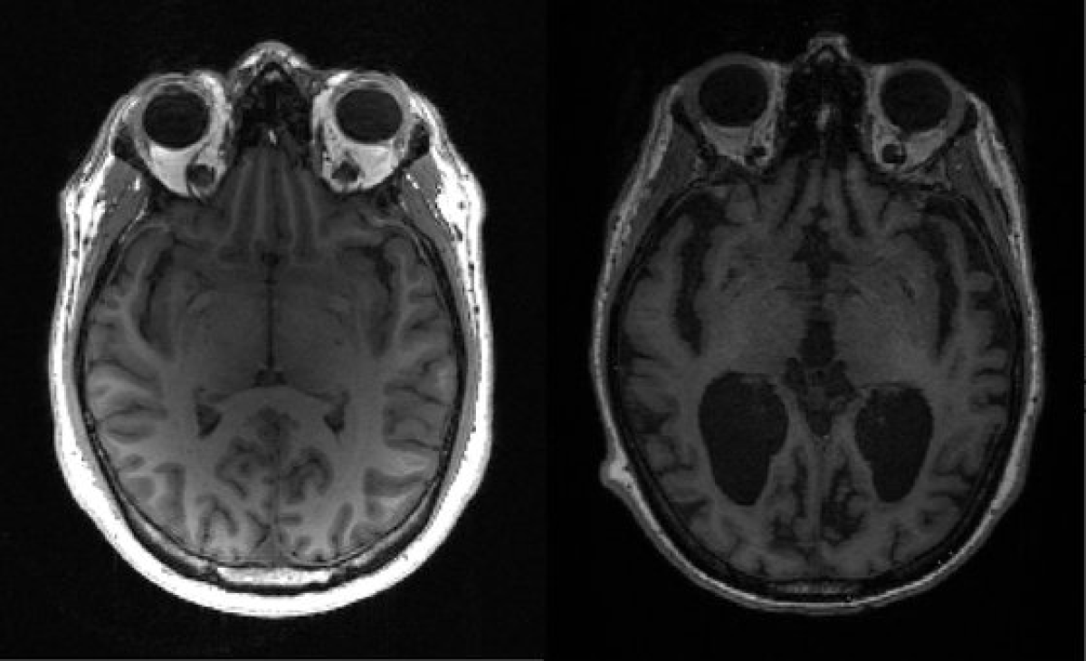 건강한 뇌(왼쪽)와 알츠하이머를 앓고 있는 환자의 뇌. [AFP=연합뉴스]