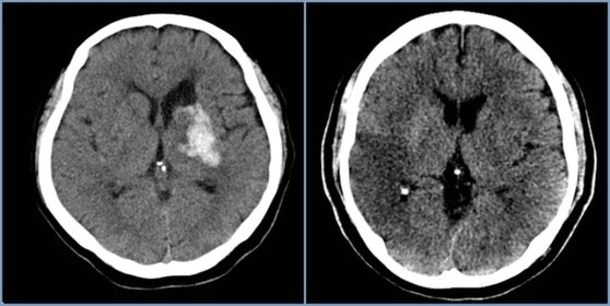 뇌출혈 환자 사진(왼쪽)과 뇌경색 환자 사진(오른쪽). [사진 분당서울대병원]